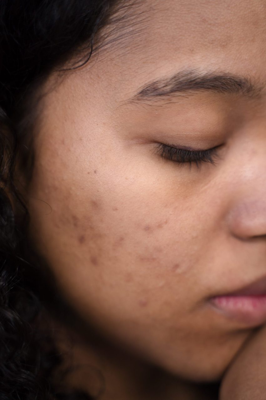 Acne: What Causes It and How It’s Treated